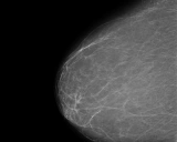 深度神经网络在乳腺癌筛查中的应用及其性能评估