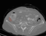 Medical-SAM2: 基于SAM2的医学影像分割新突破
